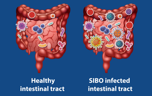 SIBO infected intestinal tract