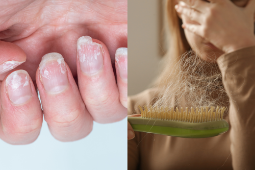 Brittle nails, hair loss low stomach acid symptom