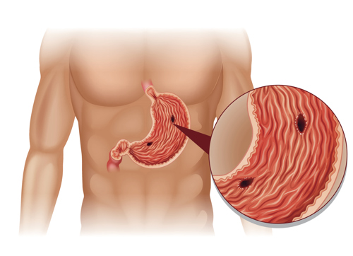 Stomach Ulcer from Low Stomach Acid