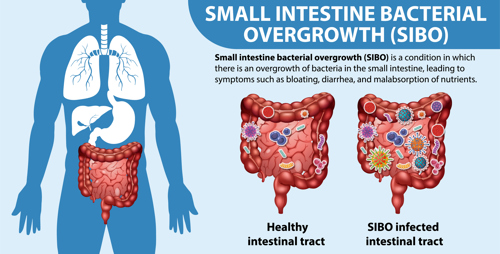 SIBO Explainer Chart